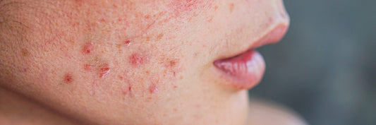 What Causes Age Spots and Sun Spots After 40 and How to Fade Them